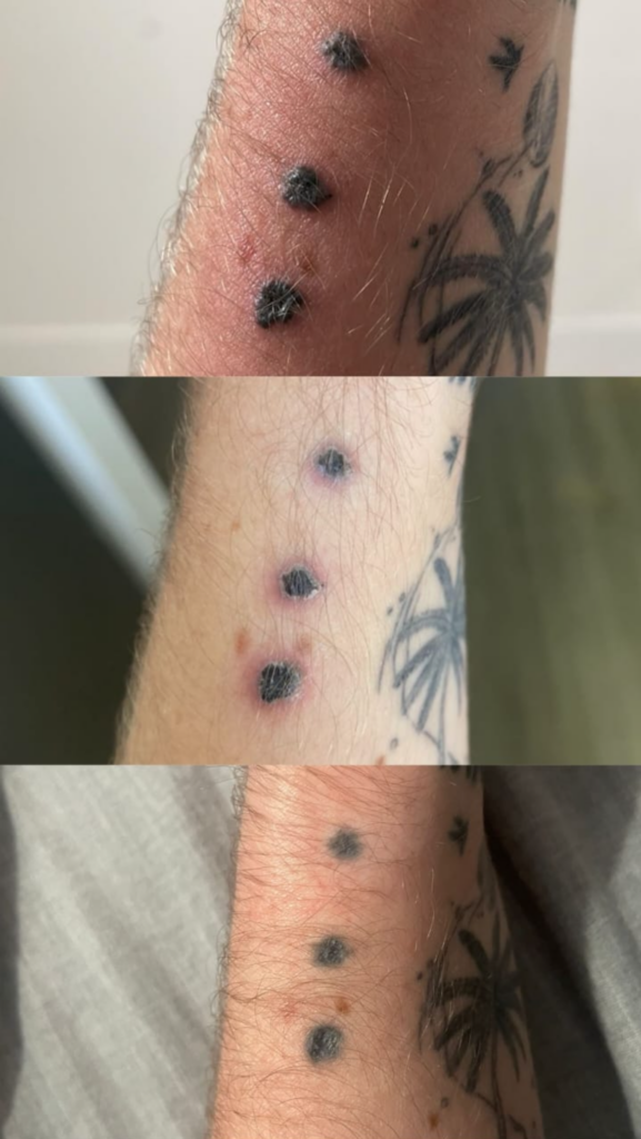 3 Stages of healing